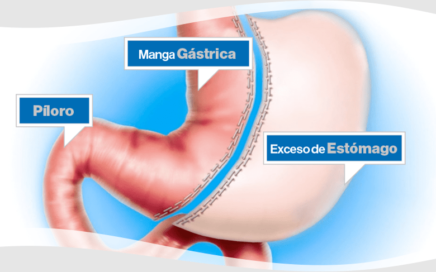 Operación de manga gástrica o cirugía tubular.