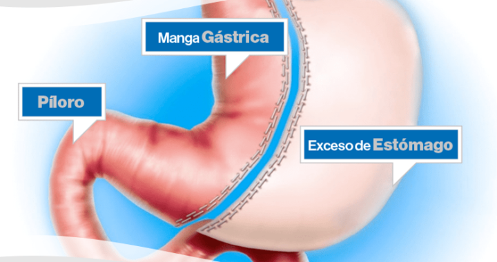 Operación de manga gástrica o cirugía tubular.